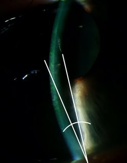 slit lmap of acute angle glaucoma